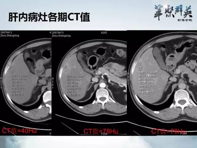 【病例】肝胆管腺瘤1例CT及MR影像表现