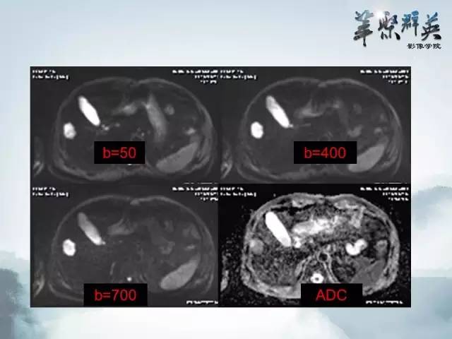 【病例】肝胆管腺瘤1例CT及MR影像表现