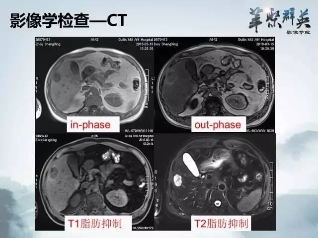 【病例】肝胆管腺瘤1例CT及MR影像表现