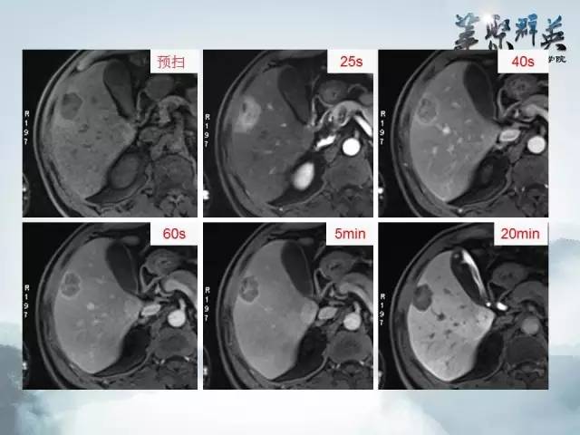 【病例】肝胆管腺瘤1例CT及MR影像表现