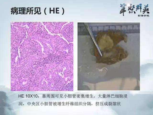 【病例】肝胆管腺瘤1例CT及MR影像表现
