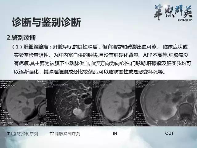 【病例】肝胆管腺瘤1例CT及MR影像表现