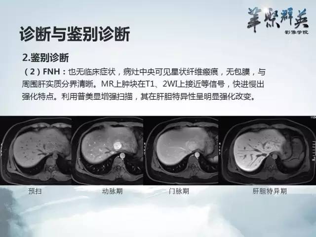 【病例】肝胆管腺瘤1例CT及MR影像表现