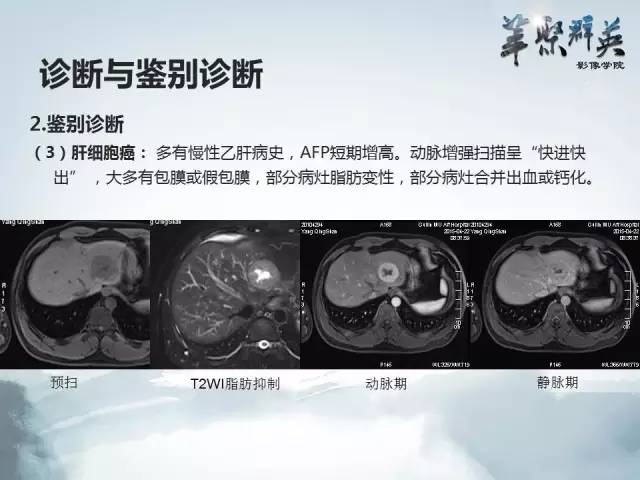 【病例】肝胆管腺瘤1例CT及MR影像表现