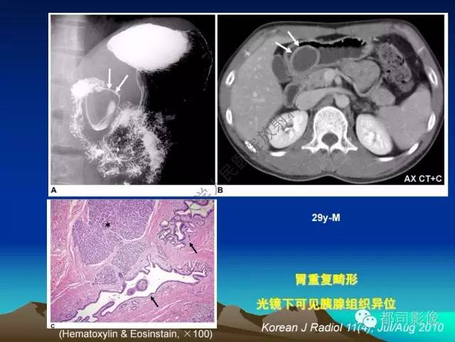 【PPT】胃肠道囊性病变的影像学诊断