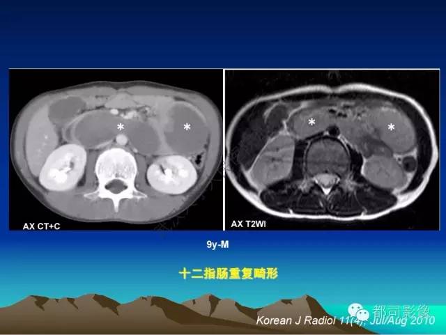 【PPT】胃肠道囊性病变的影像学诊断
