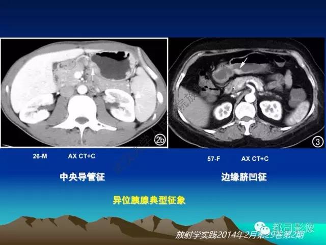 【PPT】胃肠道囊性病变的影像学诊断