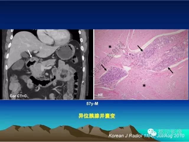 【PPT】胃肠道囊性病变的影像学诊断