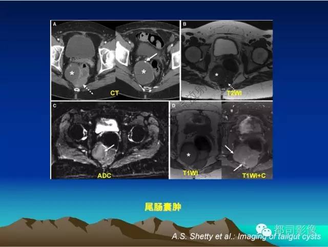 【PPT】胃肠道囊性病变的影像学诊断