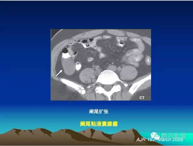 【PPT】胃肠道囊性病变的影像学诊断