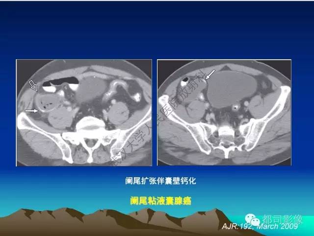 【PPT】胃肠道囊性病变的影像学诊断
