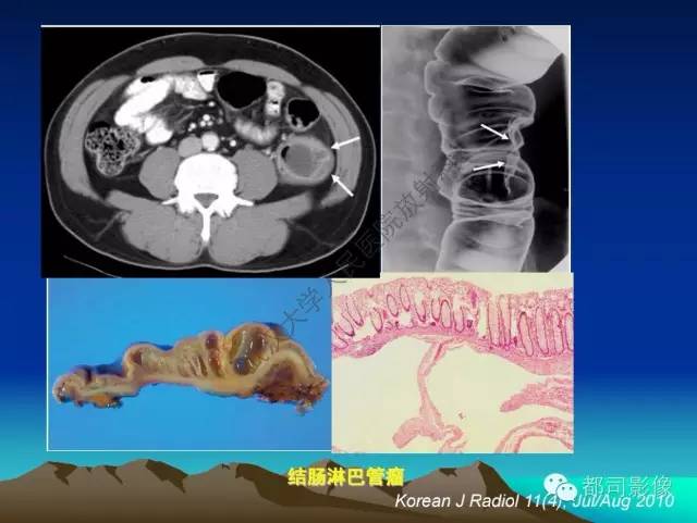 【PPT】胃肠道囊性病变的影像学诊断