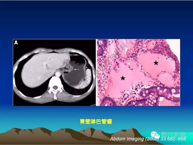 【PPT】胃肠道囊性病变的影像学诊断