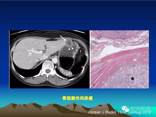 【PPT】胃肠道囊性病变的影像学诊断
