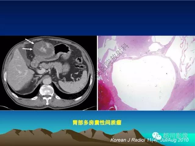 【PPT】胃肠道囊性病变的影像学诊断