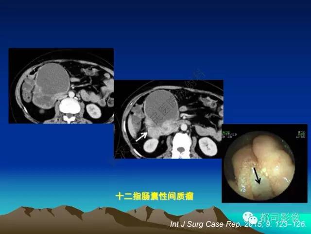 【PPT】胃肠道囊性病变的影像学诊断