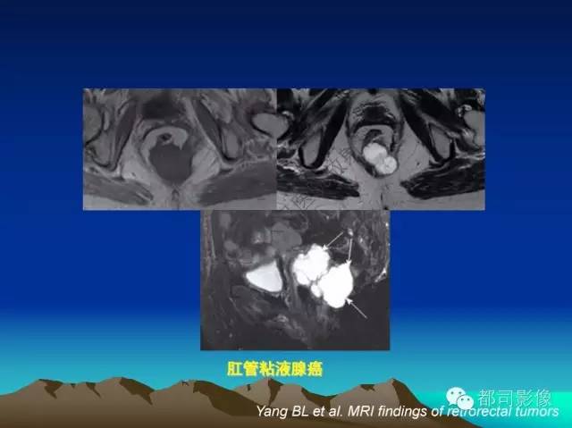 【PPT】胃肠道囊性病变的影像学诊断