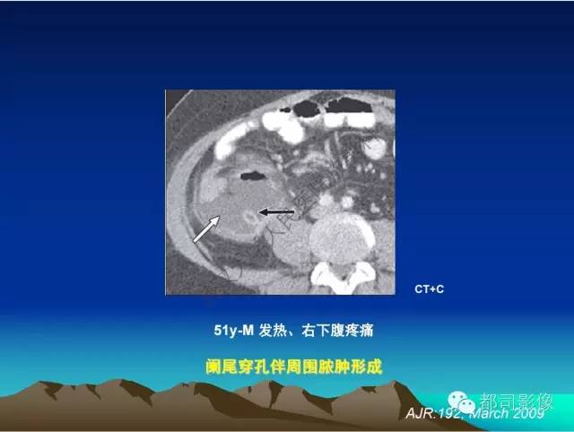【PPT】胃肠道囊性病变的影像学诊断