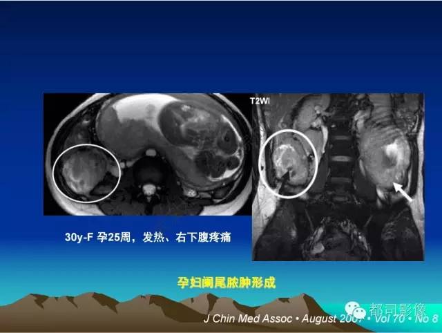 【PPT】胃肠道囊性病变的影像学诊断