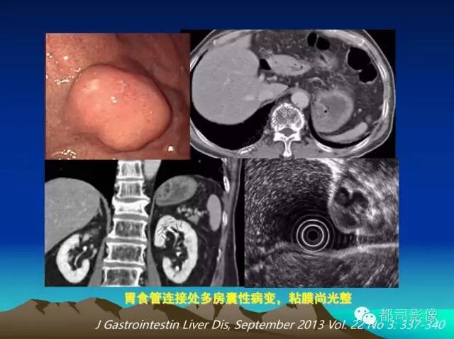 【PPT】胃肠道囊性病变的影像学诊断