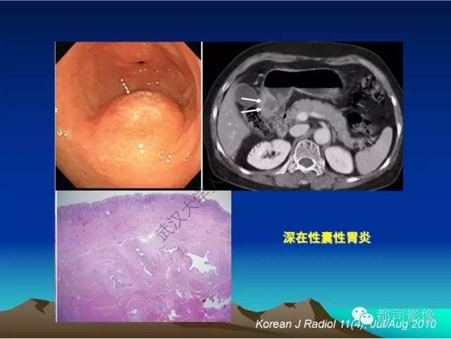 【PPT】胃肠道囊性病变的影像学诊断