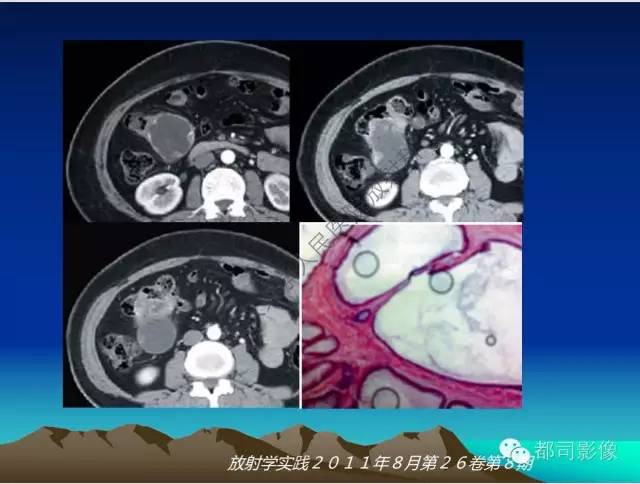 【PPT】胃肠道囊性病变的影像学诊断