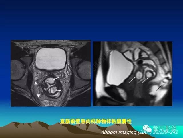 【PPT】胃肠道囊性病变的影像学诊断