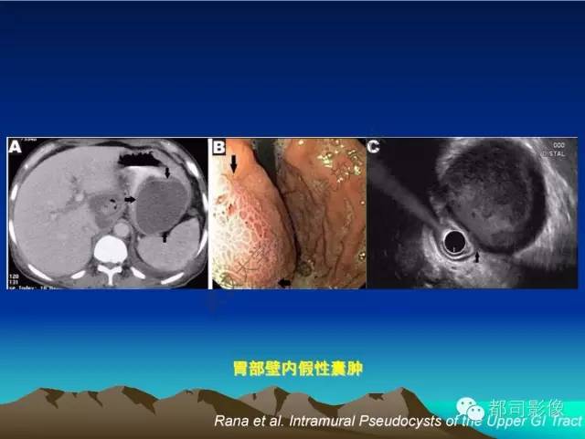 【PPT】胃肠道囊性病变的影像学诊断