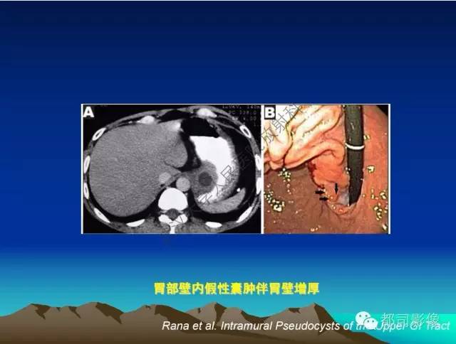 【PPT】胃肠道囊性病变的影像学诊断