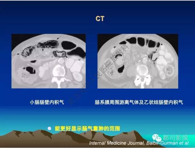 【PPT】胃肠道囊性病变的影像学诊断