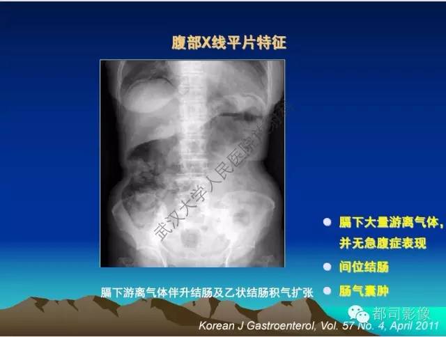 【PPT】胃肠道囊性病变的影像学诊断
