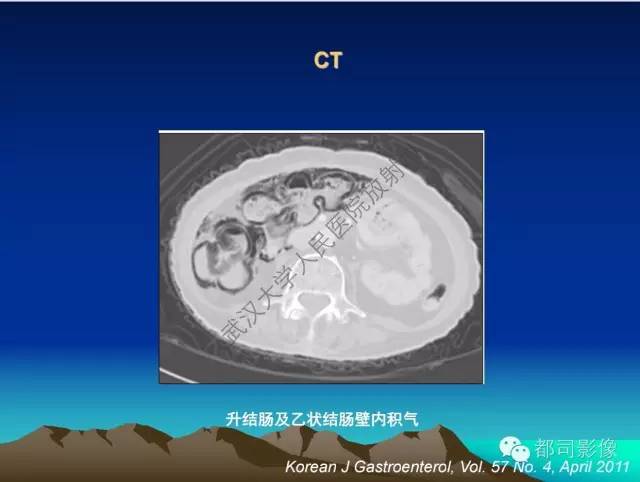 【PPT】胃肠道囊性病变的影像学诊断