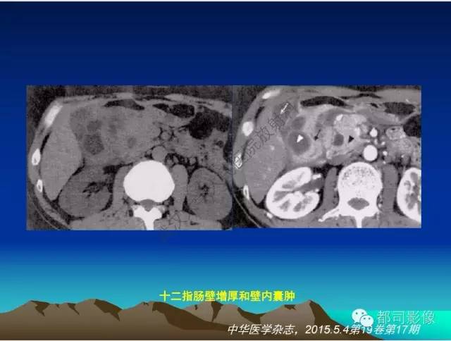 【PPT】胃肠道囊性病变的影像学诊断