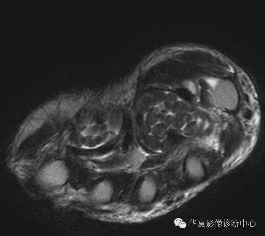 【病例】米粒体性滑膜炎1例MR影像表现