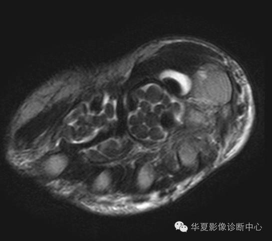 【病例】米粒体性滑膜炎1例MR影像表现 【病例】米粒体性滑膜炎1例MR影像表现