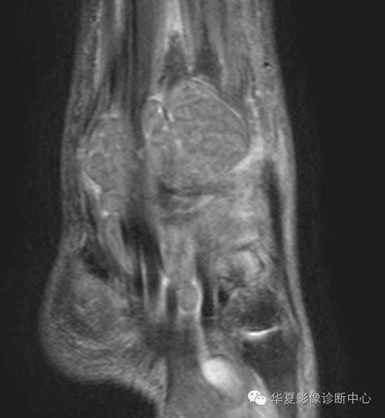【病例】米粒体性滑膜炎1例MR影像表现 【病例】米粒体性滑膜炎1例MR影像表现