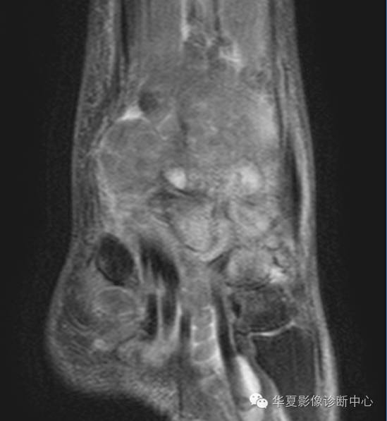 【病例】米粒体性滑膜炎1例MR影像表现 【病例】米粒体性滑膜炎1例MR影像表现