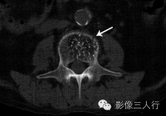 "斑点征"，这个征象提示啥？