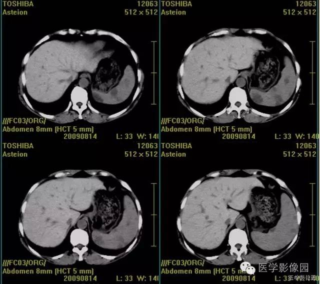 【病例】脾脏血管淋巴管瘤（脉管瘤）1例CT影像表现