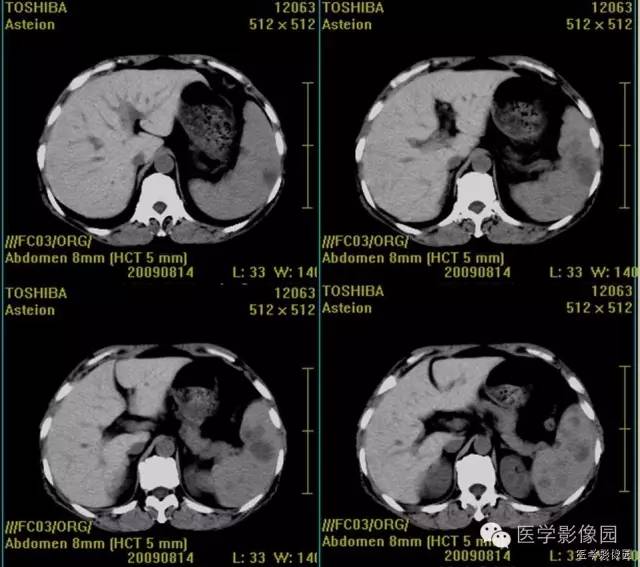 【病例】脾脏血管淋巴管瘤(脉管瘤)1例CT影像表现 【病例】脾脏血管淋巴管瘤(脉管瘤)1例CT影像表现