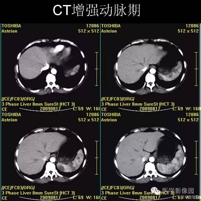 【病例】脾脏血管淋巴管瘤(脉管瘤)1例CT影像表现 【病例】脾脏血管淋巴管瘤(脉管瘤)1例CT影像表现