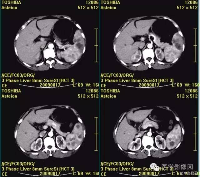【病例】脾脏血管淋巴管瘤(脉管瘤)1例CT影像表现 【病例】脾脏血管淋巴管瘤(脉管瘤)1例CT影像表现