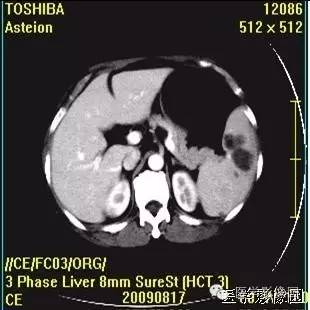【病例】脾脏血管淋巴管瘤(脉管瘤)1例CT影像表现 【病例】脾脏血管淋巴管瘤(脉管瘤)1例CT影像表现