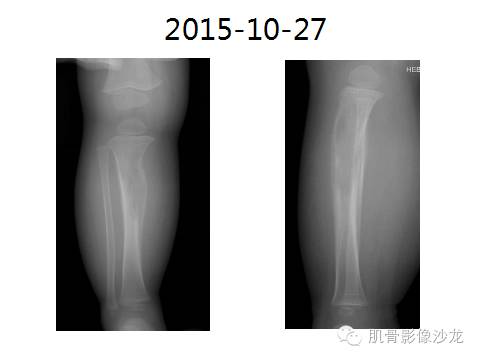 【病例】胫骨嗜酸性肉芽肿1例X线影像讨论