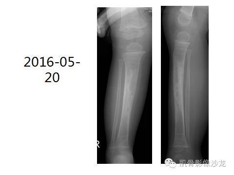 【病例】胫骨嗜酸性肉芽肿1例X线影像讨论