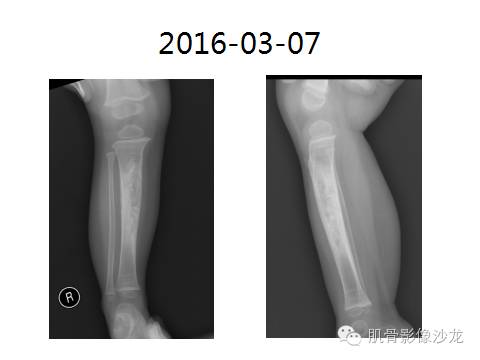 【病例】胫骨嗜酸性肉芽肿1例X线影像讨论