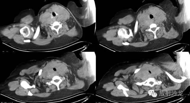 桥本甲状腺炎（Hashimoto thyroiditis，HT）