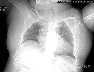 桥本甲状腺炎(Hashimoto thyroiditis,HT) 桥本甲状腺炎(Hashimoto thyroiditis,HT)