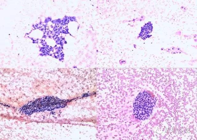 桥本甲状腺炎(Hashimoto thyroiditis,HT) 桥本甲状腺炎(Hashimoto thyroiditis,HT)