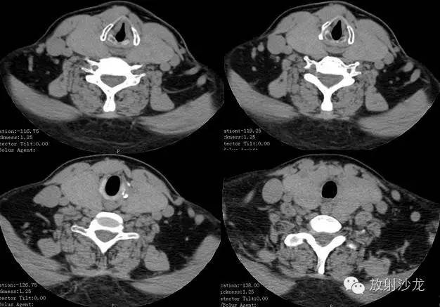 桥本甲状腺炎(Hashimoto thyroiditis,HT) 桥本甲状腺炎(Hashimoto thyroiditis,HT)